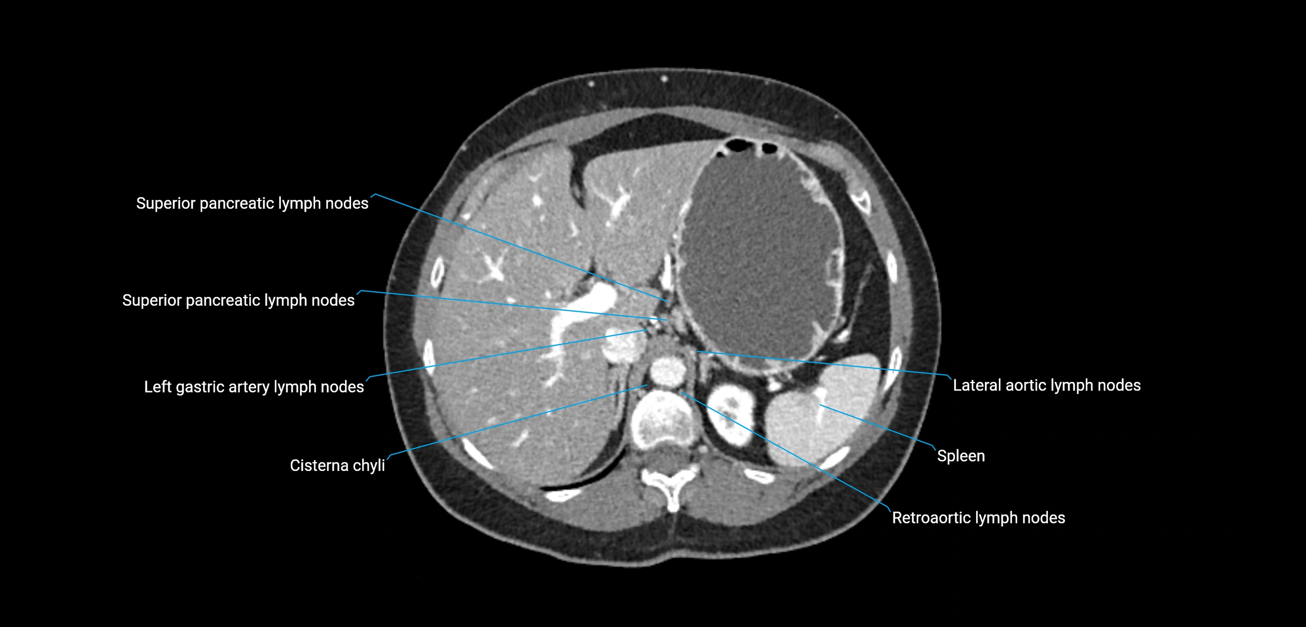 CT ct abdominal lymph nodes  axial cross sectional anatomy  enchanced radiology image -img-00002-00127.webp